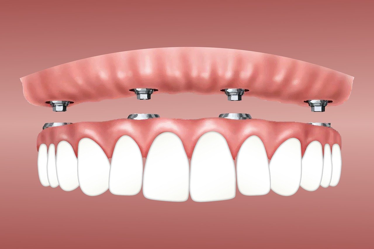 Dental implants00