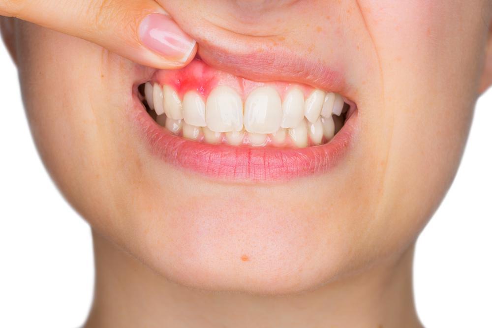 signs of periodontal disease